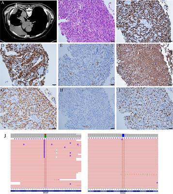 An advanced pulmonary sarcomatoid carcinoma patient harboring a BRAFV600E mutation responds to dabrafenib and trametinib: a case report and literature review